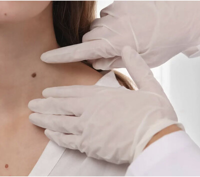 Link to: /pages/mole-skin-tag-removal