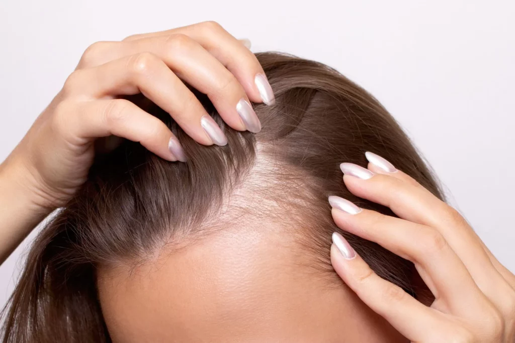 Girl showing hair lines seeking for Hair Loss Treatment | The Space Aesthetics in San Mateo, CA