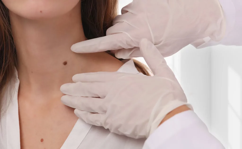 Aesthetician Reviewing Mole and skin tag at Space Aesthetics in San Mateo, CA