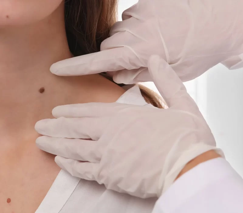 Aesthetician Reviewing Mole and skin tag at Space Aesthetics in San Mateo, CA