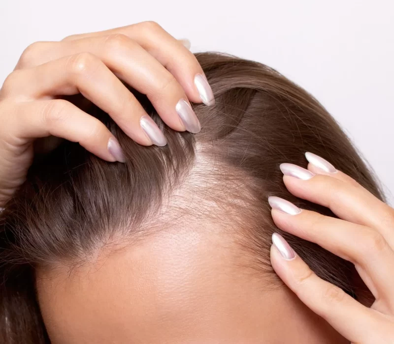 Girl showing hair lines seeking for Hair Loss Treatment | The Space Aesthetics in San Mateo, CA