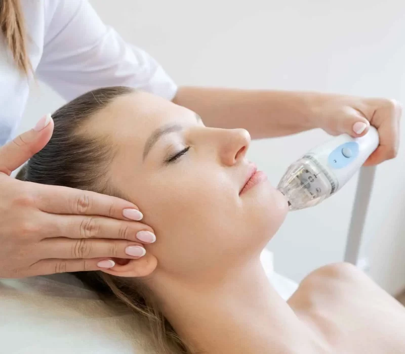 Lady receiving RF Microneedling at The Space Aesthetics in San Mateo, CA